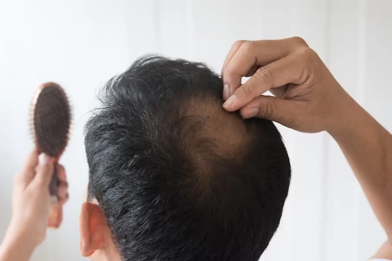 hairfall remedy