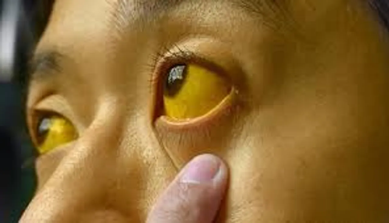 jaundice