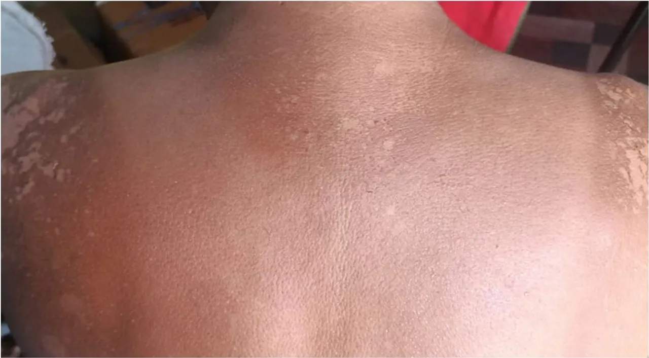 sunburn