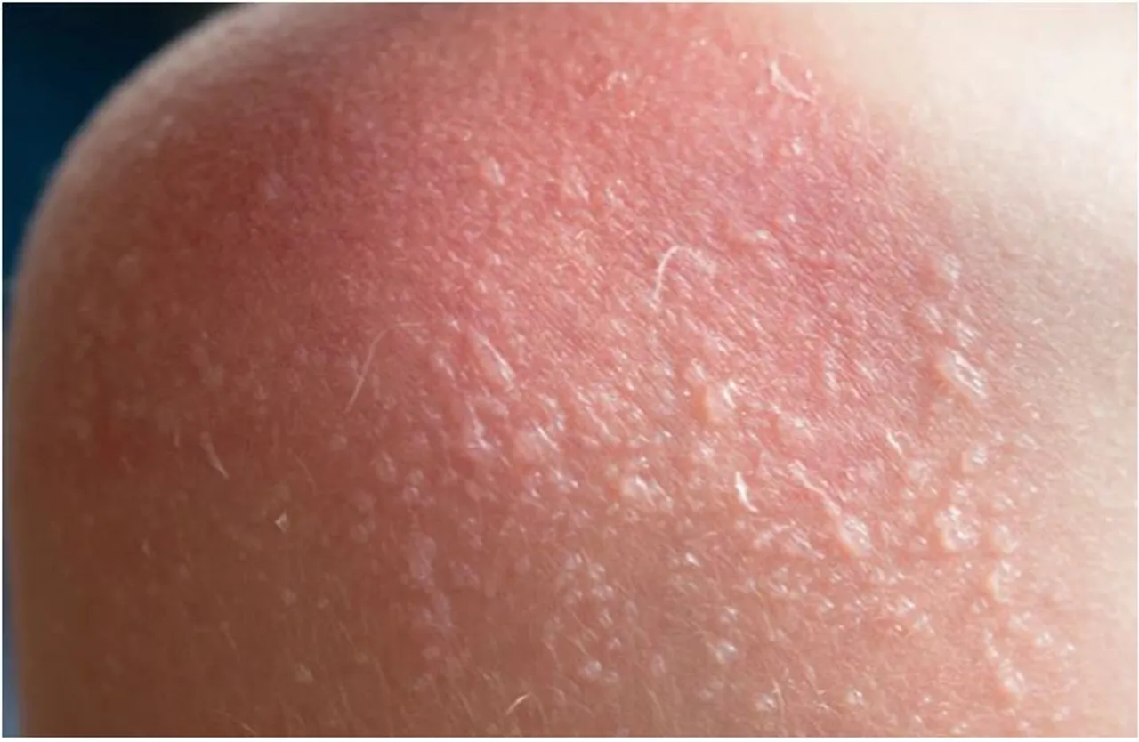 sunburn