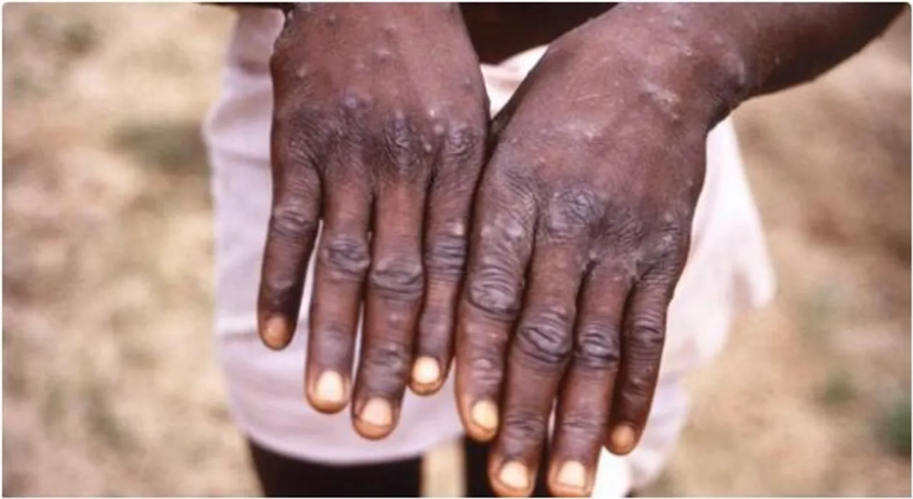 mpox