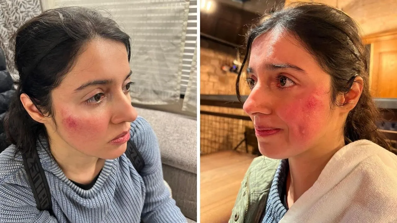 Divya Khosla Kumar Injured