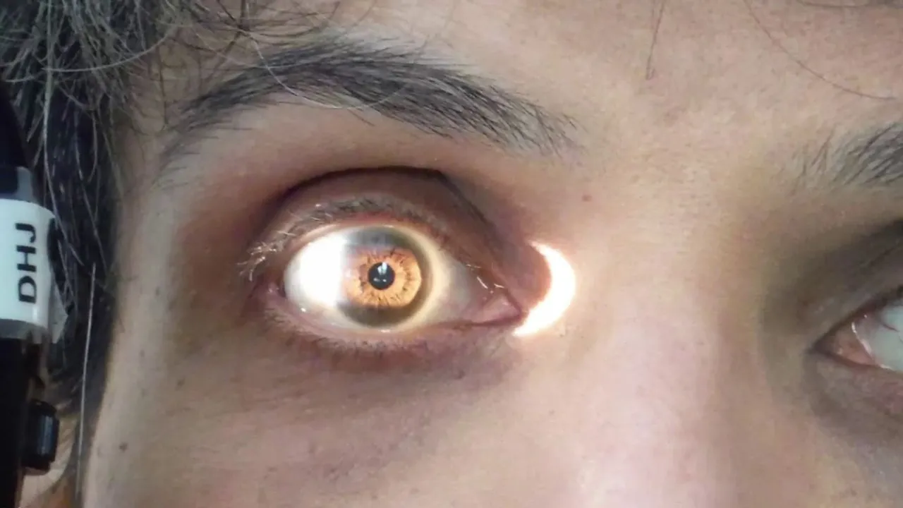 eye test with light