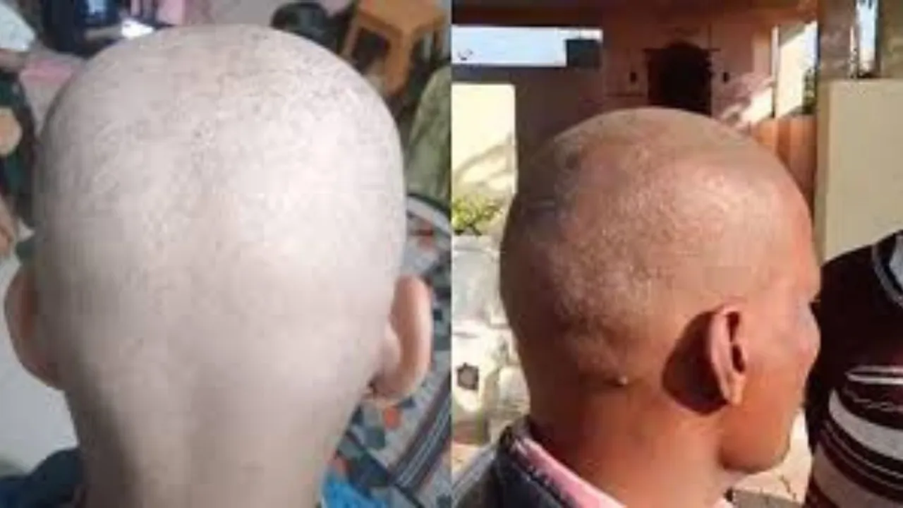 Hair loss in Buldhana Maharashtra