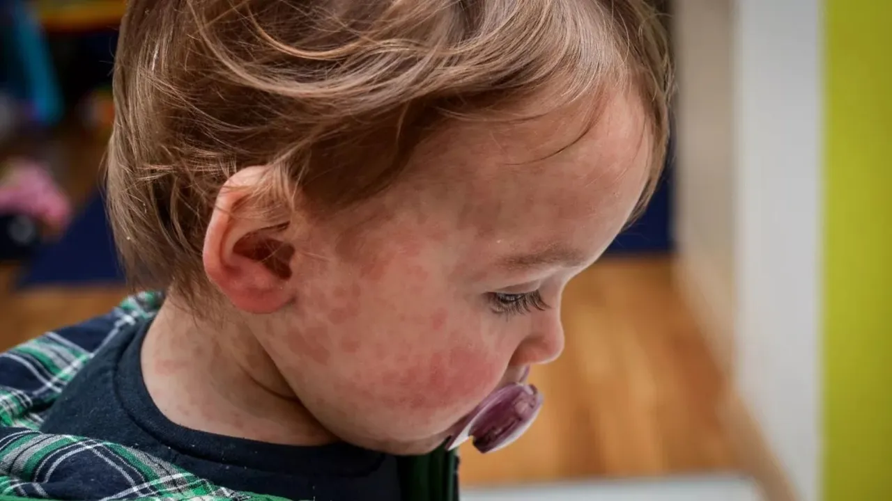 Europe measles outbreak