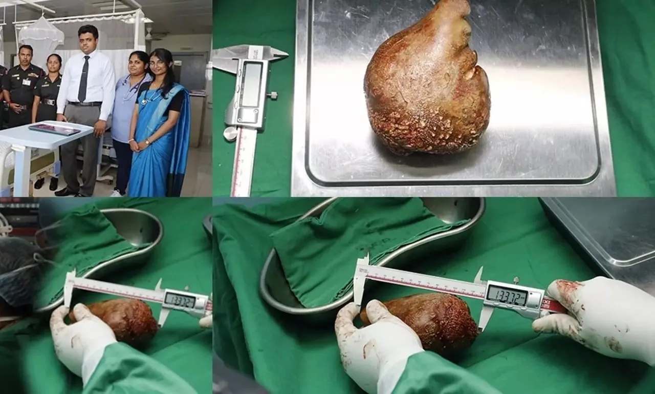 kidney stone.jpg