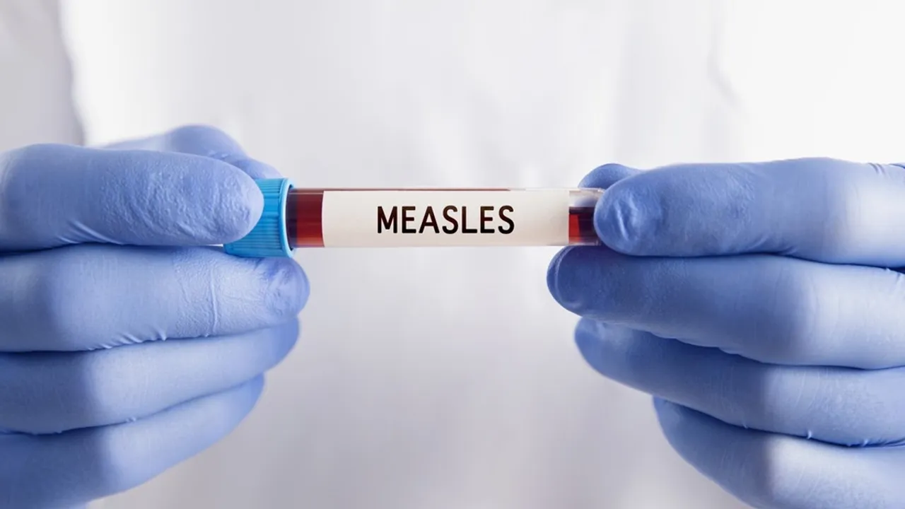 measles