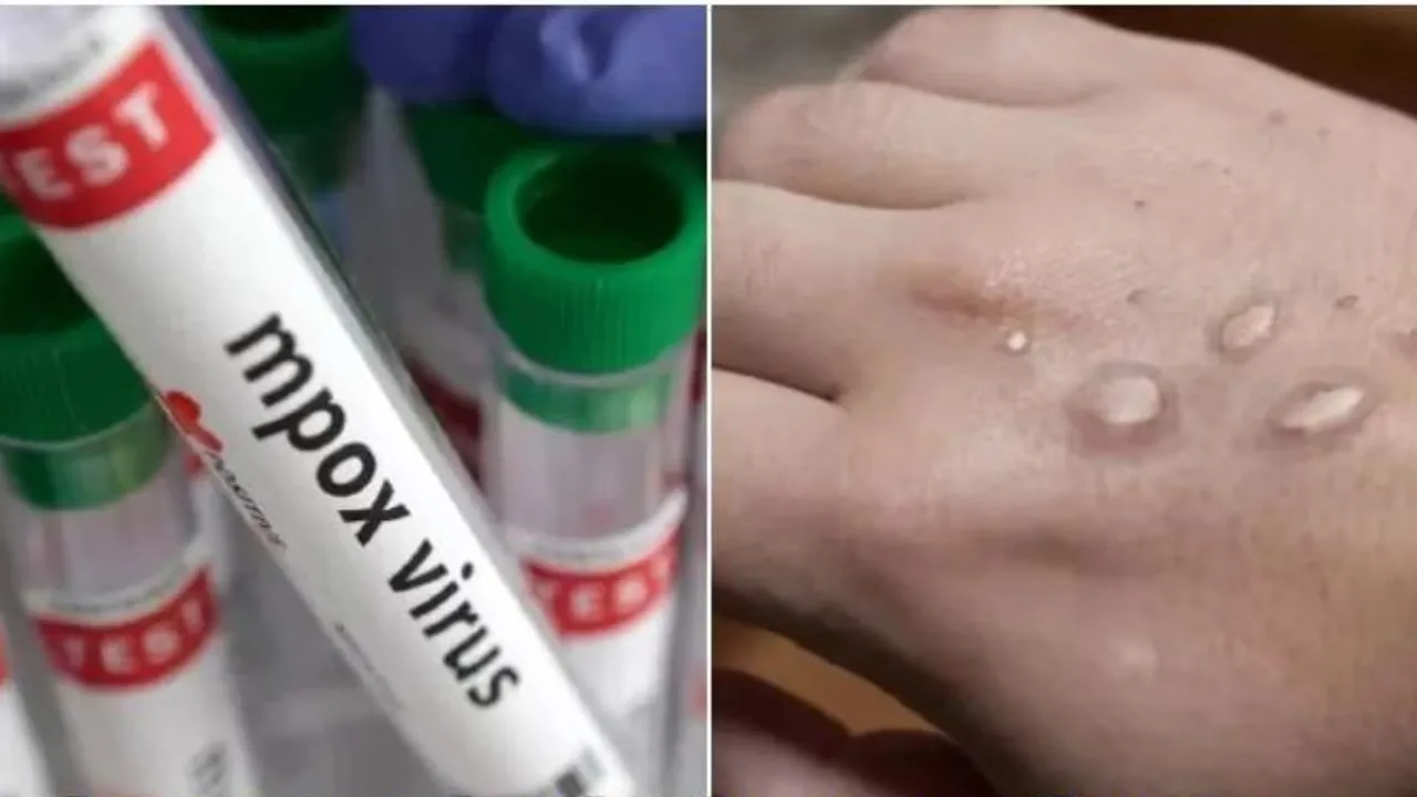 Monkey pox Monkeypox 