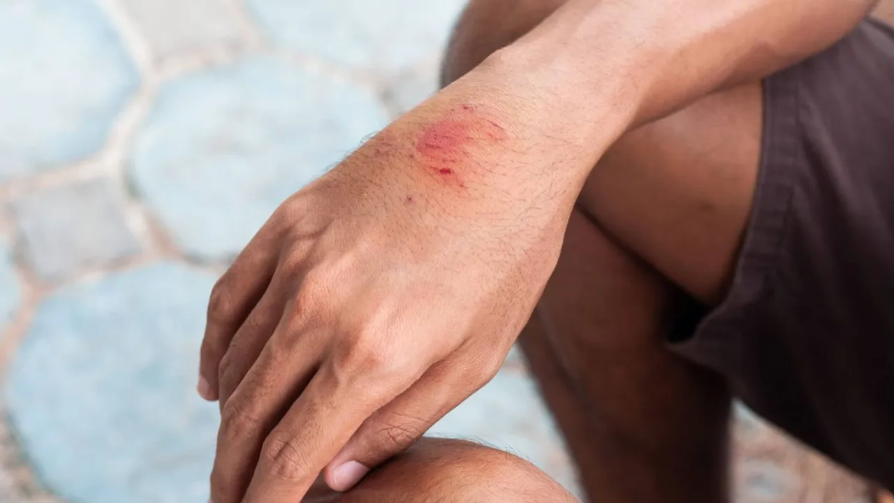 rabies dog bite