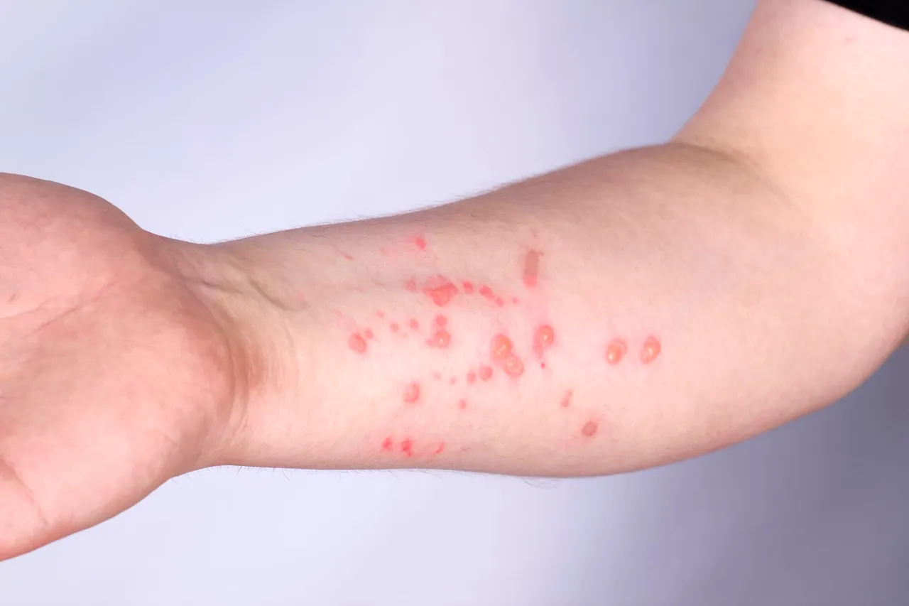 Monkeypox.jpg