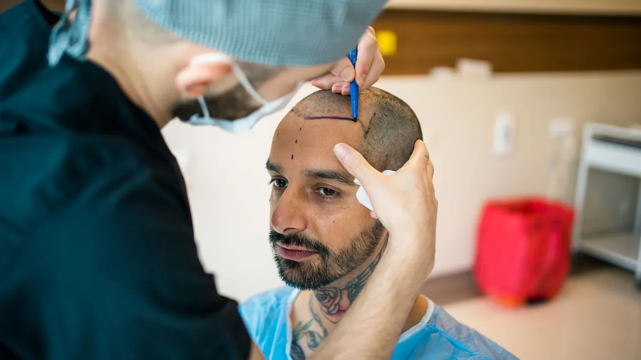 hair transplant.jpg
