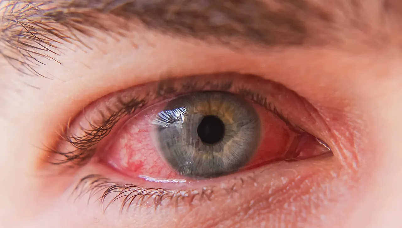 syphilis of the eye.jpg