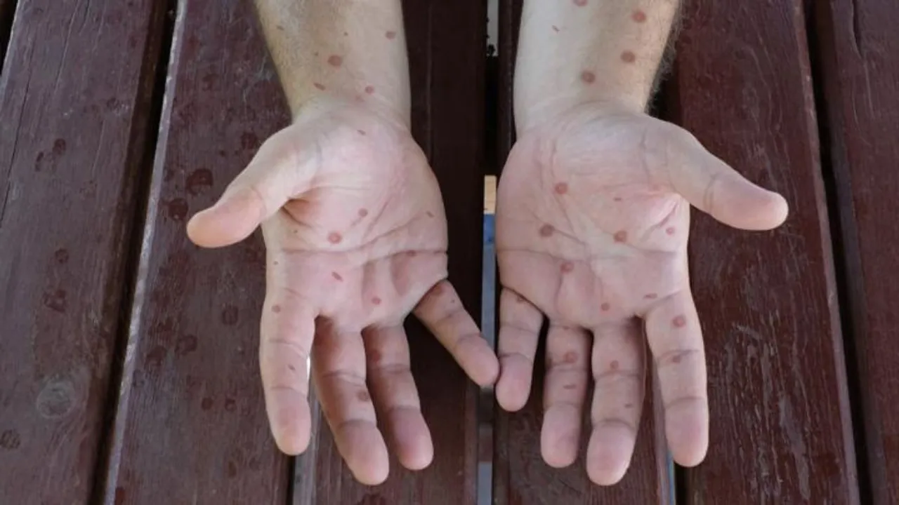 Monkey Pox MPOx