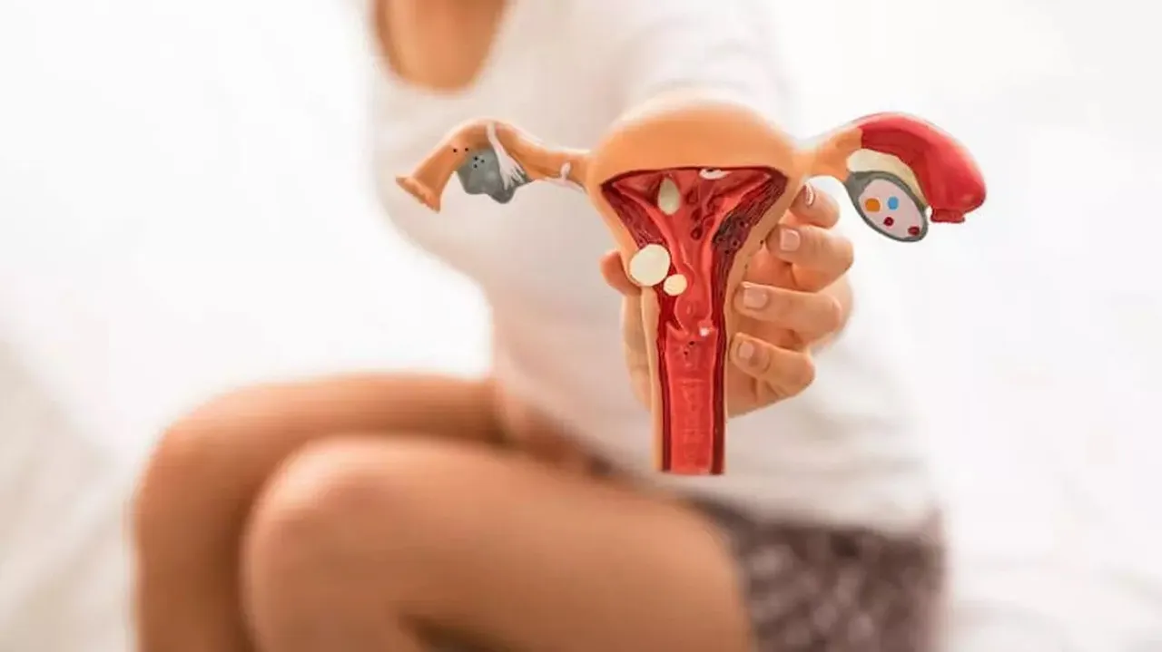 Endometriosis.jpg