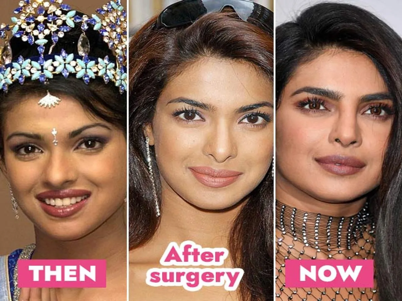 priyanka chopra surgery.jpg
