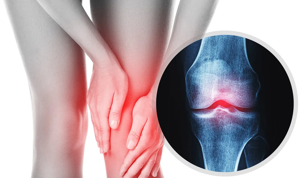 Osteoarthritis.jpeg