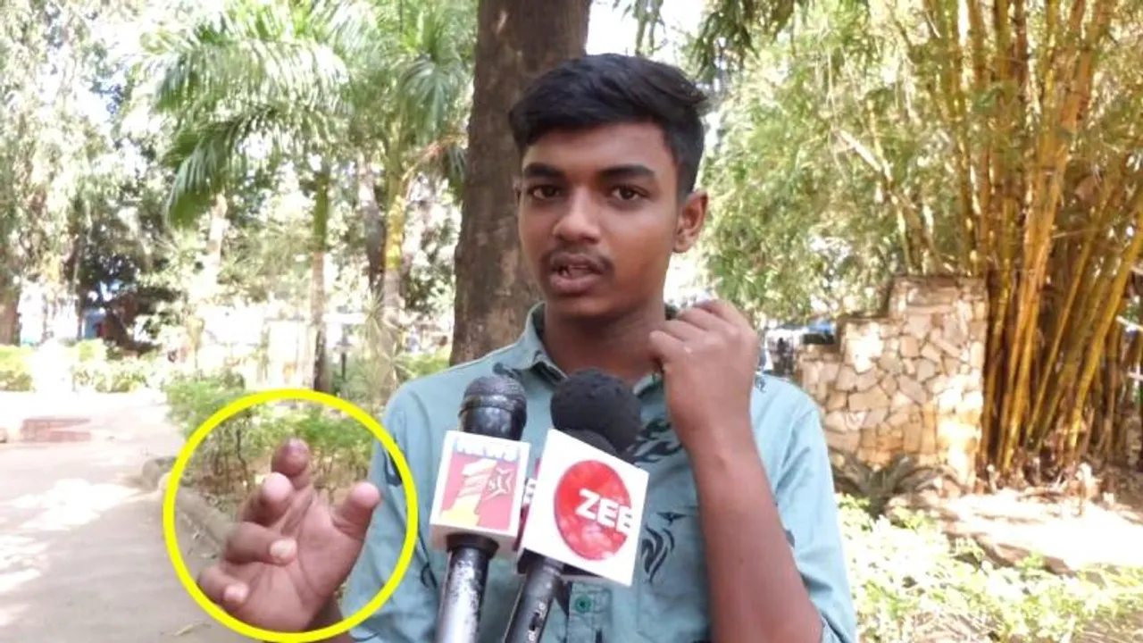 ಆಟದ ವಸ್ತುವೆಂದು ಜಿಲಿಟಿನ್ ಹಿಡಿದು ಬೆರಳು ಕಳೆದುಕೊಂಡ ಬಾಲಕ; ರಾಜಾರೋಷವಾಗಿ ಓಡಾಡಿಕೊಂಡಿರುವ ಗುತ್ತಿಗೆದಾರ!