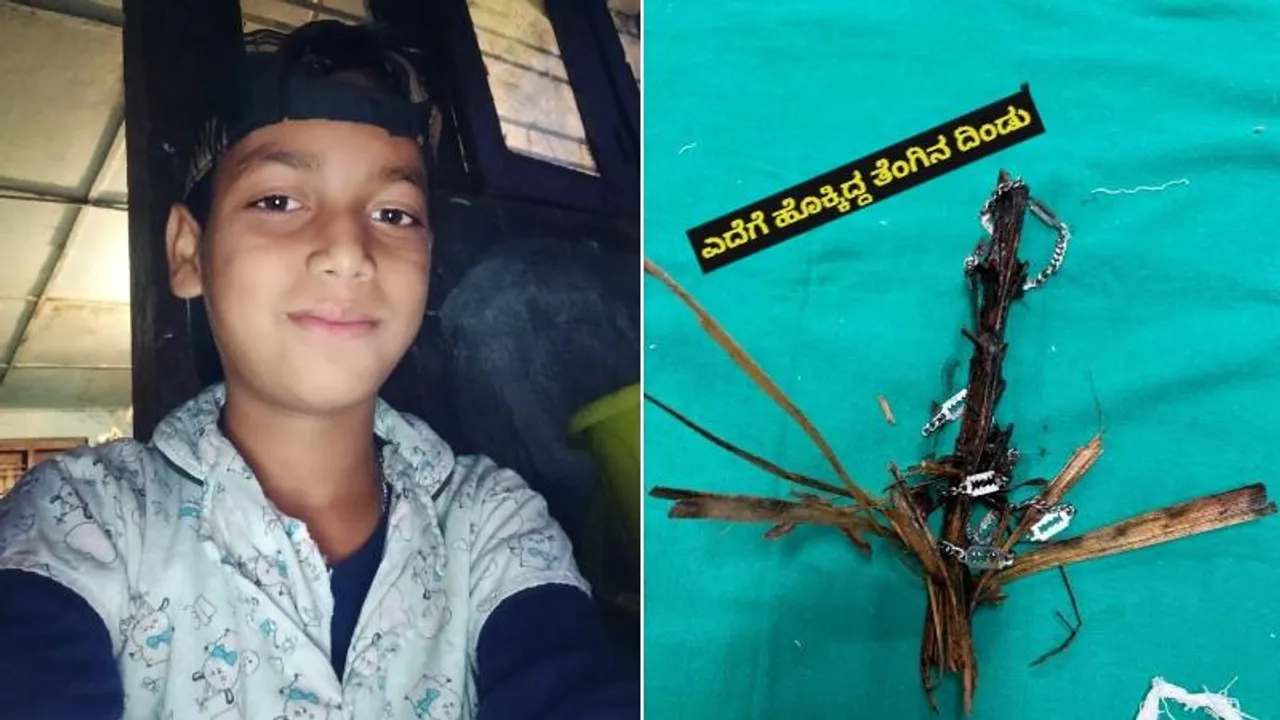 ಬಾಲಕನ ಎದೆಗೆ ಹೊಕ್ಕಿತ್ತು ತೆಂಗಿನ ಗರಿಯ ದಿಂಡು.. ಪವಾಡ ರೀತಿಯಲ್ಲಿ ಜೀವ ಉಳಿಸಿದ ಸರ್ಕಾರಿ ವೈದ್ಯ