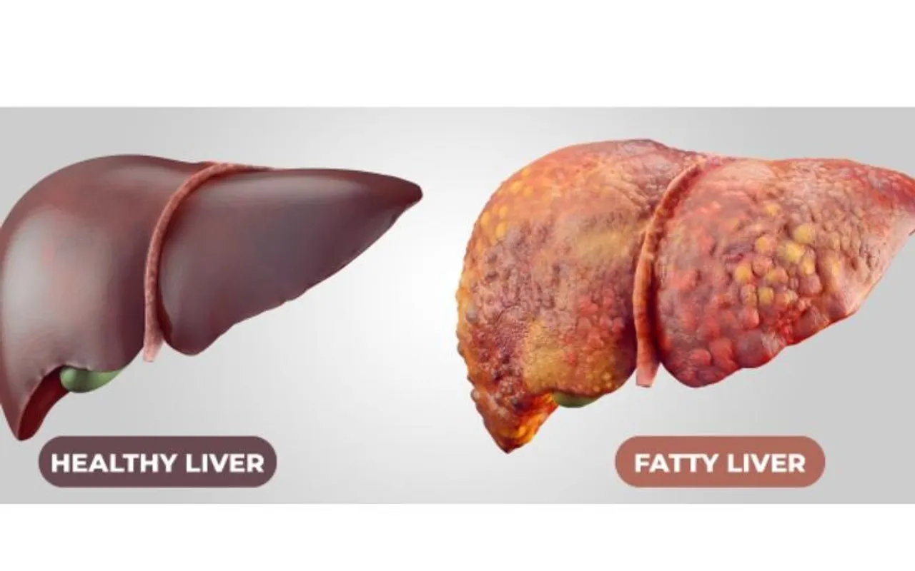 Simple steps to keep Non-alcoholic Fatty Liver Disease at bay