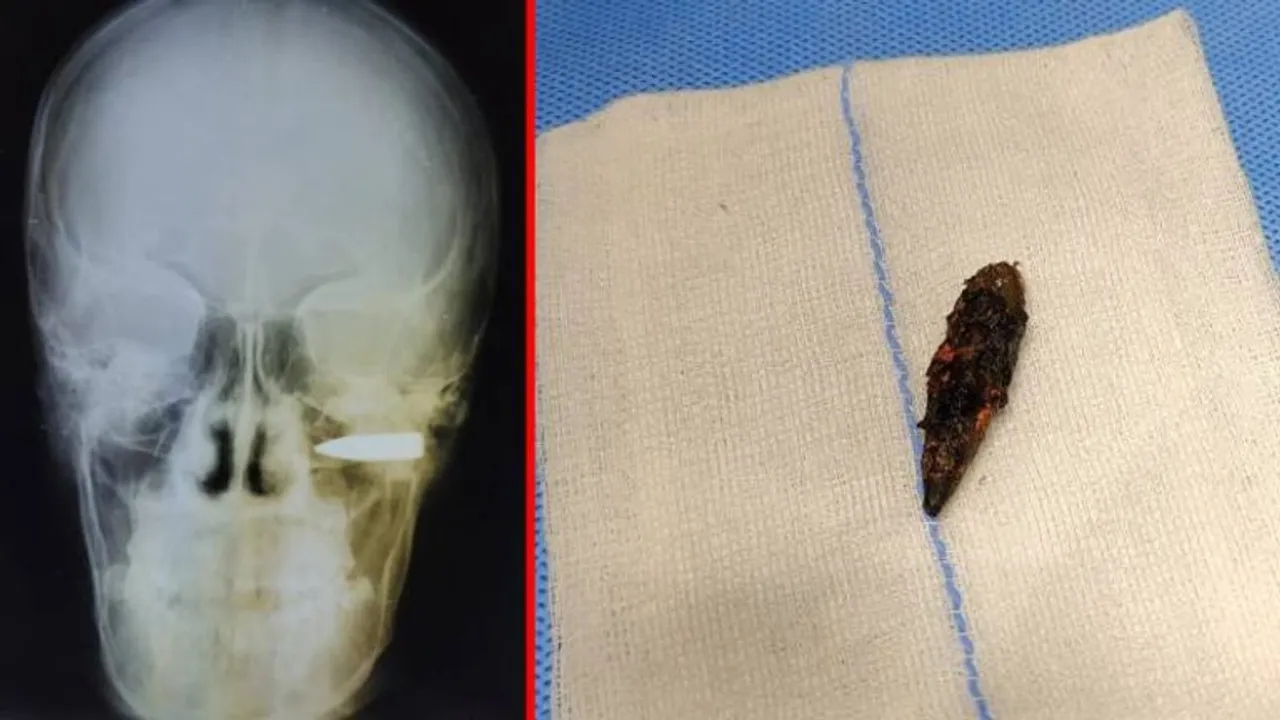 Bengaluru: Doctors dislodge bullet stuck for 18 years from patient’s head
