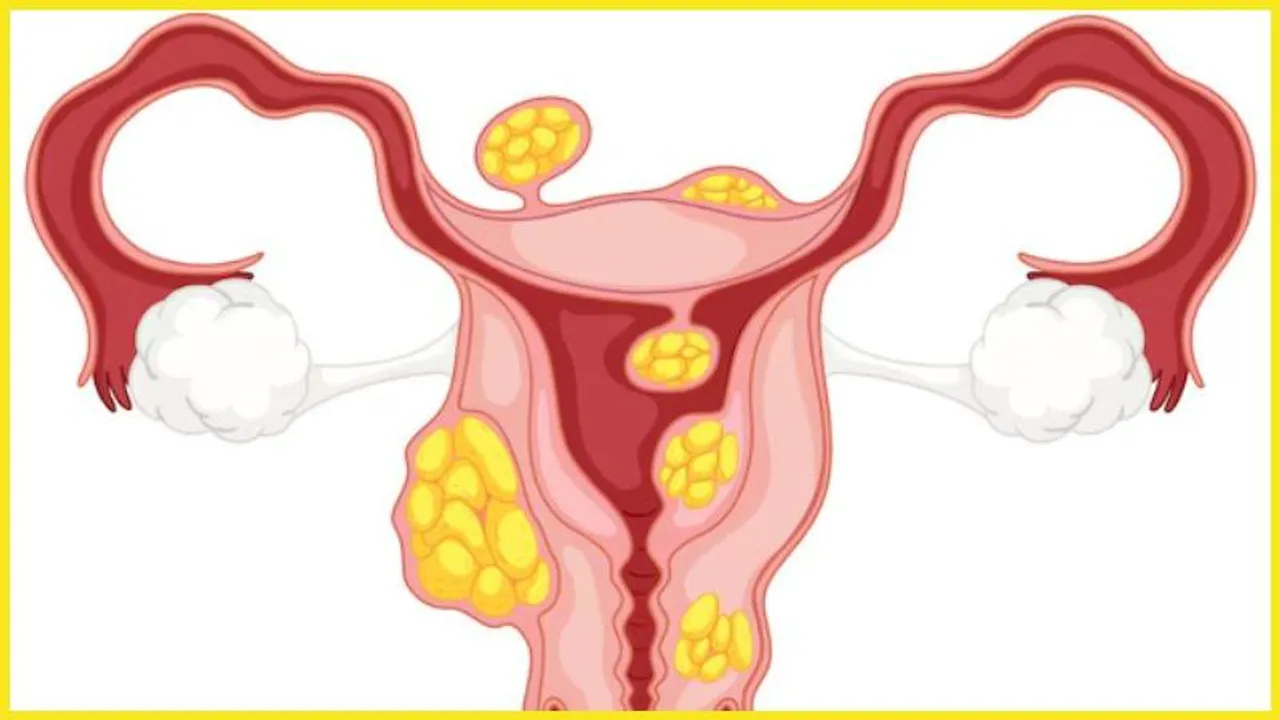 Bengaluru: Doctors remove 4 kg fibroid uterus laparoscopically for first time in South India