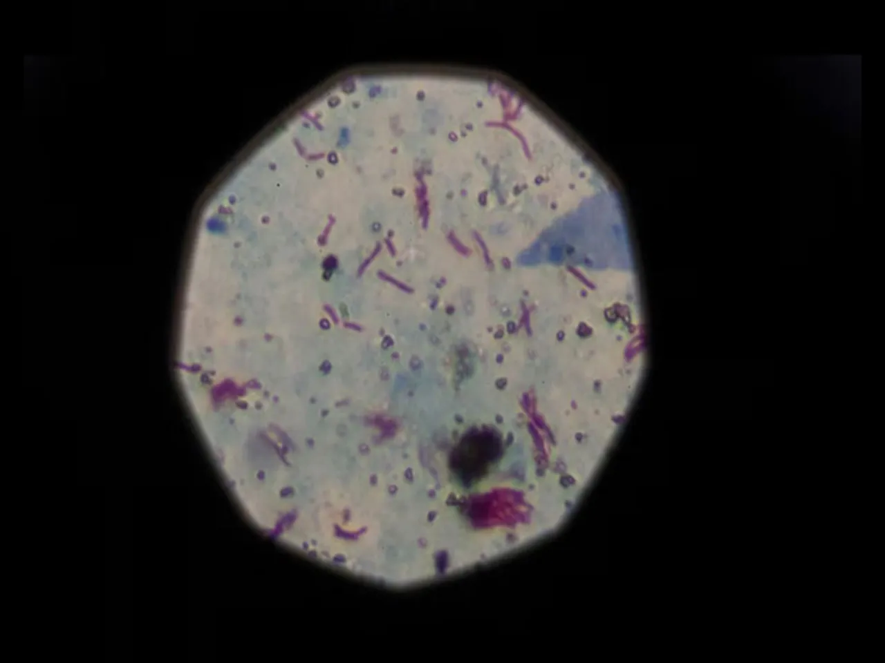 A sample that tested positive for tuberculosis is seen from a microscope (Image/Reuters)