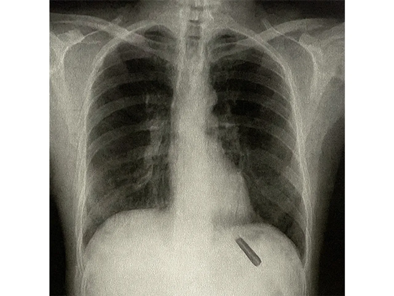 X-ray of the patient (Photo/ANI)
