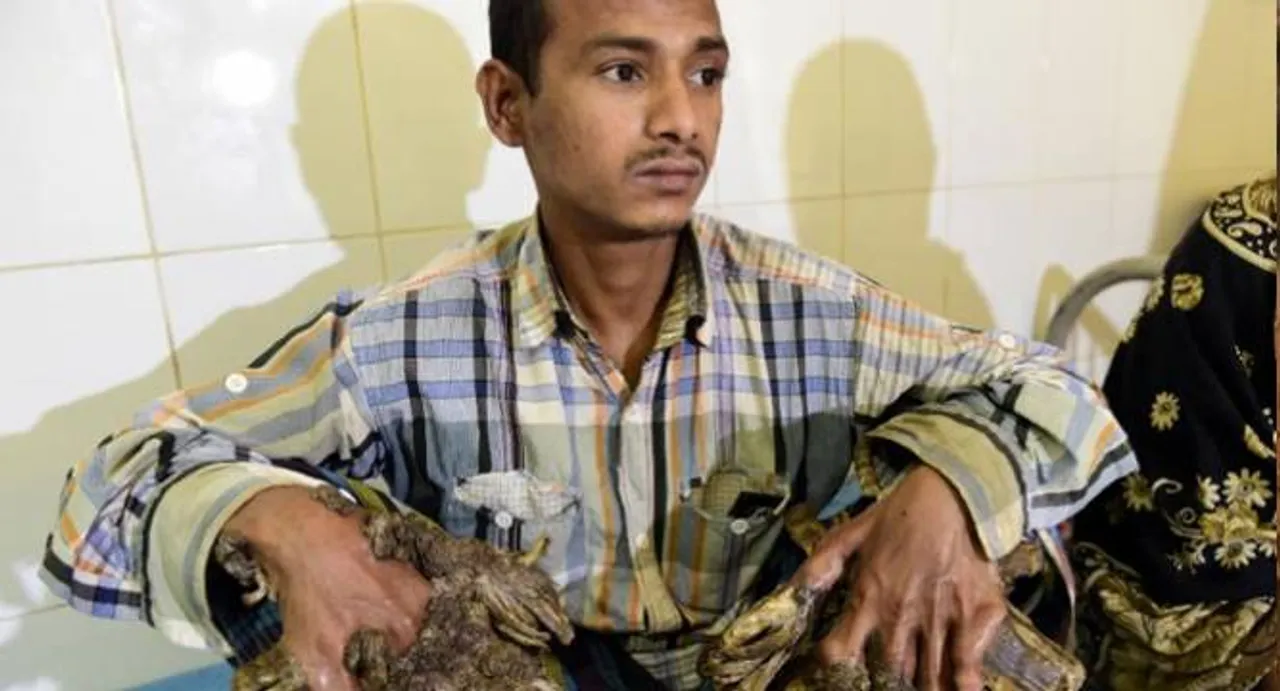 Surgery for Bangladesh's 'Tree Man' to remove warts
