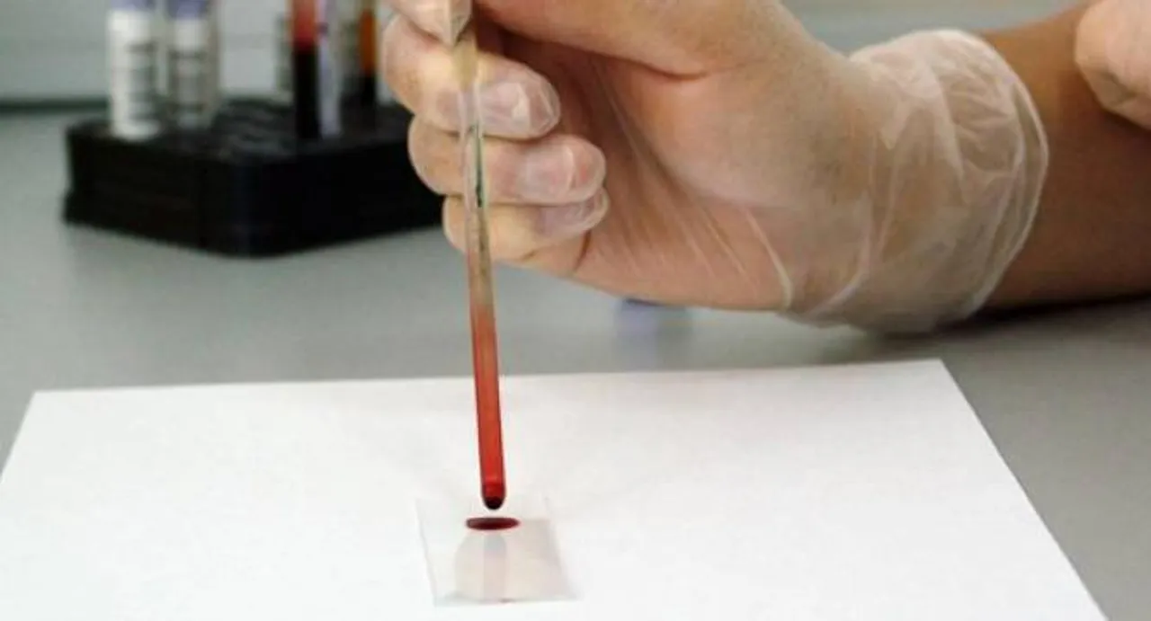 Simple blood test may spot 5 types of cancers