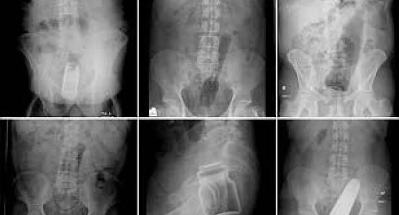 X-rays and nanoparticles combo can kill cancer: study