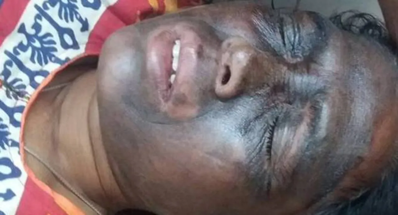 Chhattisgarh: Unidentified men hurl acid like chemical on AAP leader Soni Sori