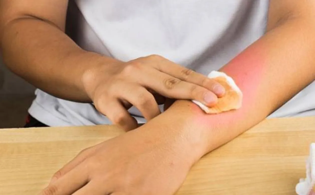 Scientists successfully create artificial skin that may help burn victims