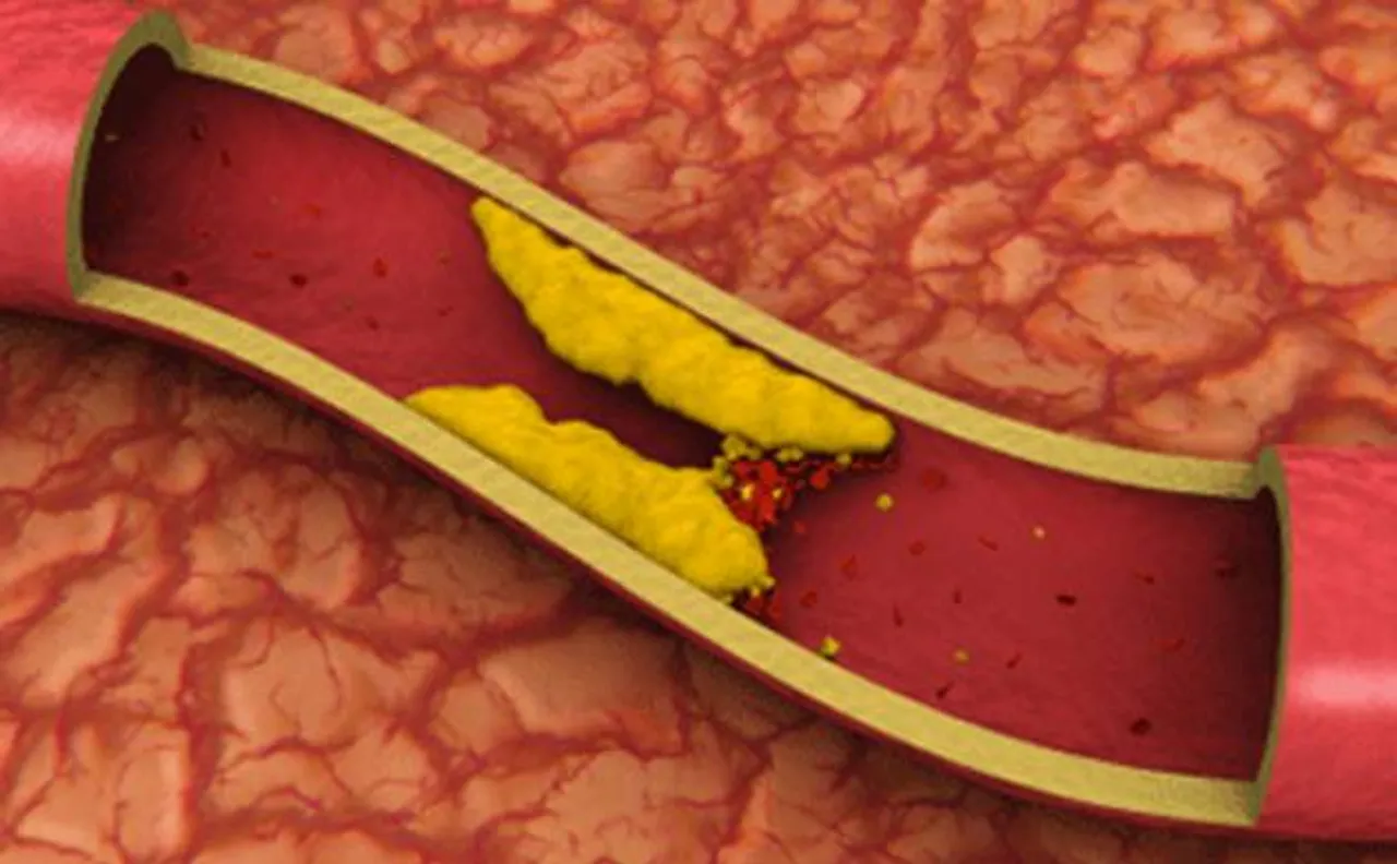 Control bad cholesterol to prevent tumour growth