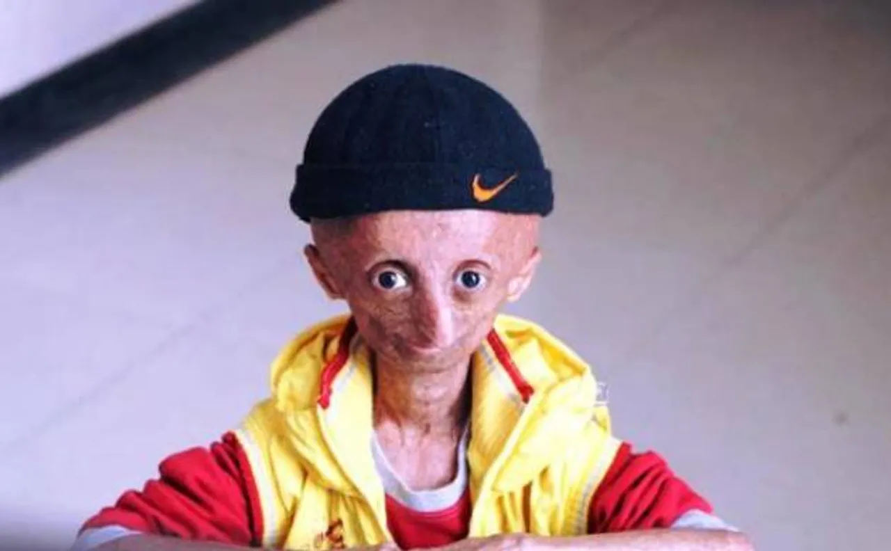 15-year-old Progeria kid Nihal Bitla passes away in Telangana