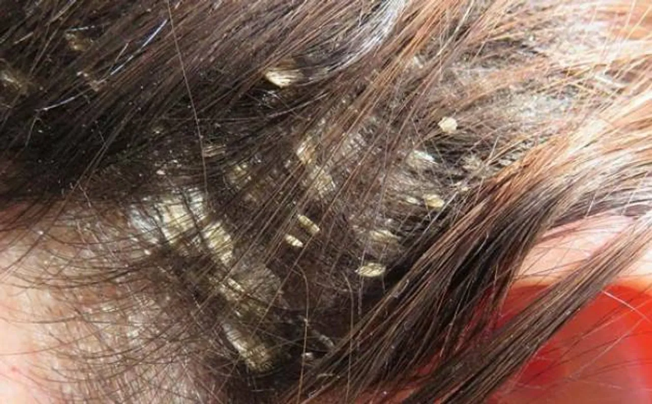 Imbalance between two bacteria may trigger dandruff, says study