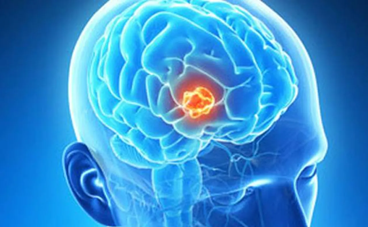 Brain tumour can be cured by 'nanocarrier', say Researchers