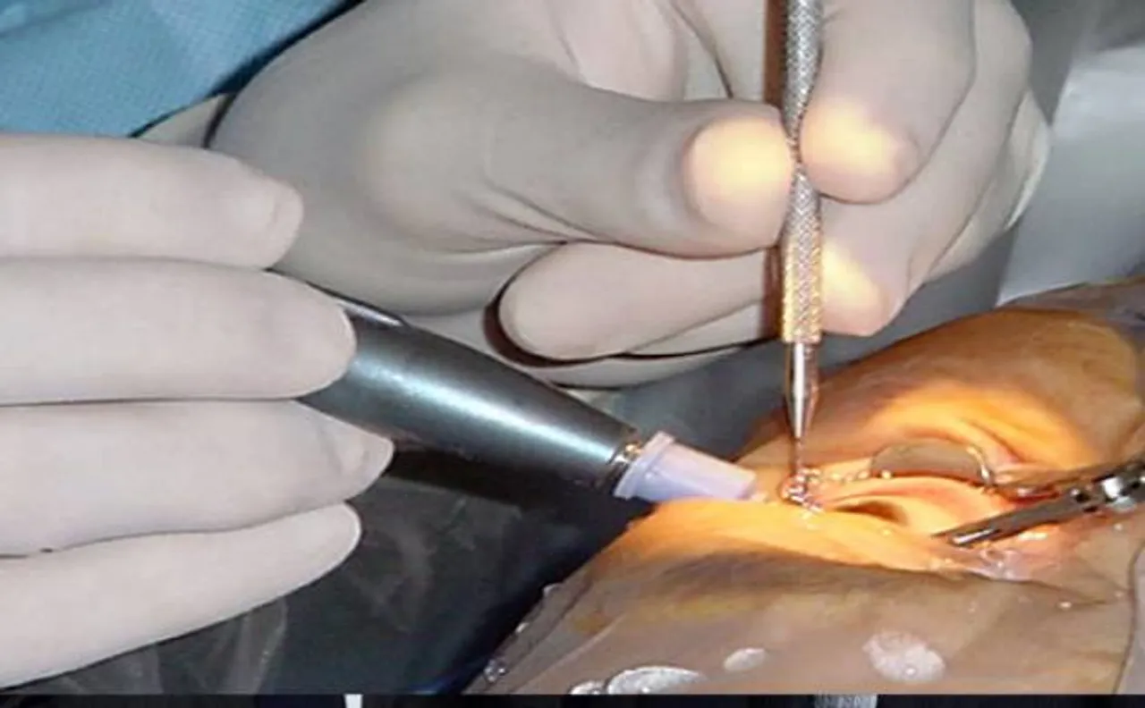 Eye of two men removed following careless cataract surgery