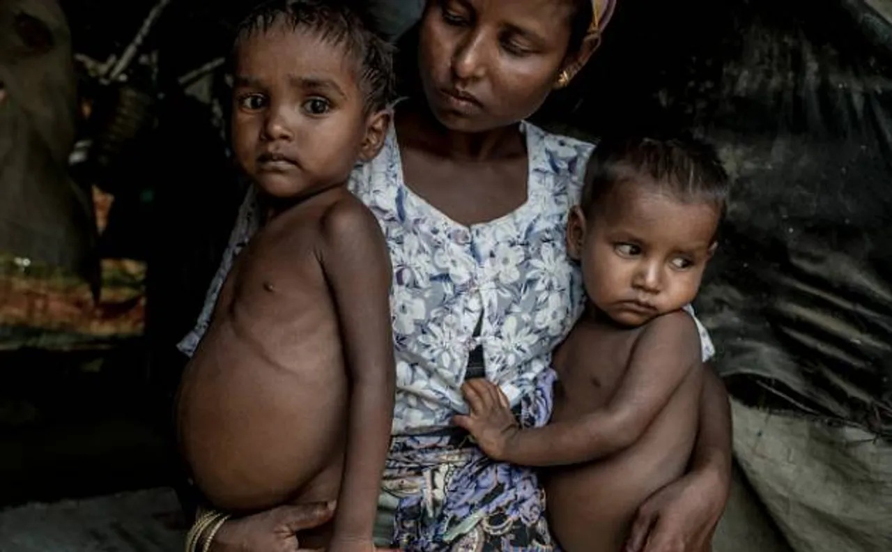 Four-year-old girl suffering from severe malnutrition dies in Maharashtra 