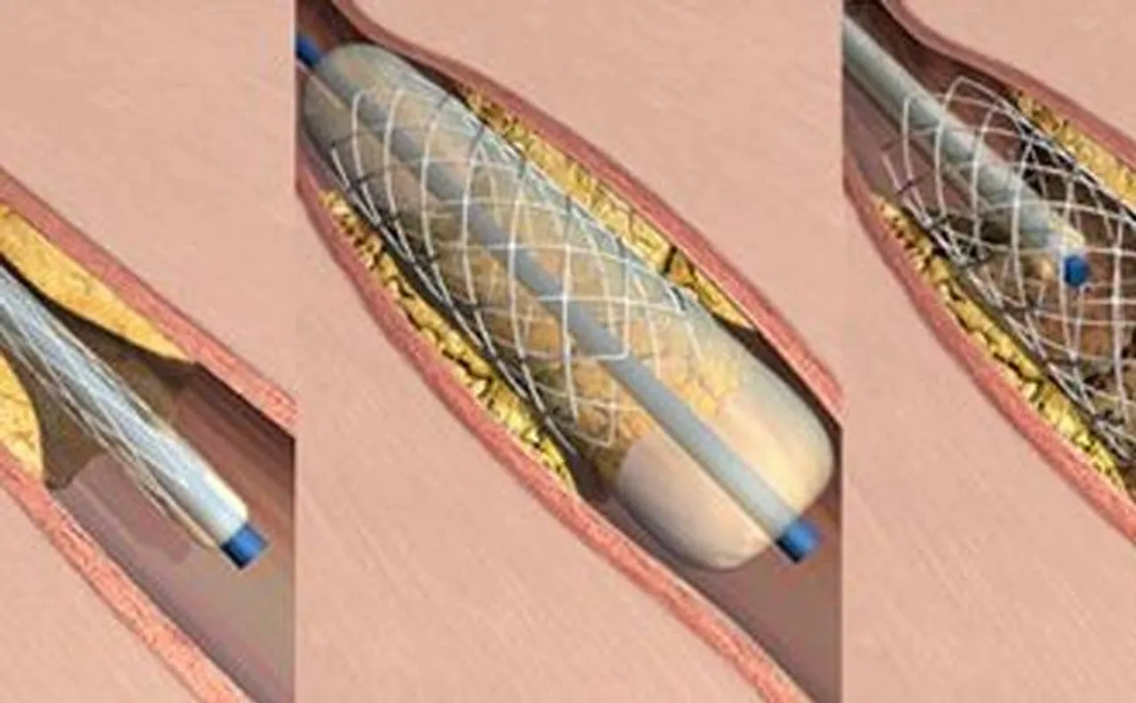 Will take action against those who create crisis of coronary stents, says Centre