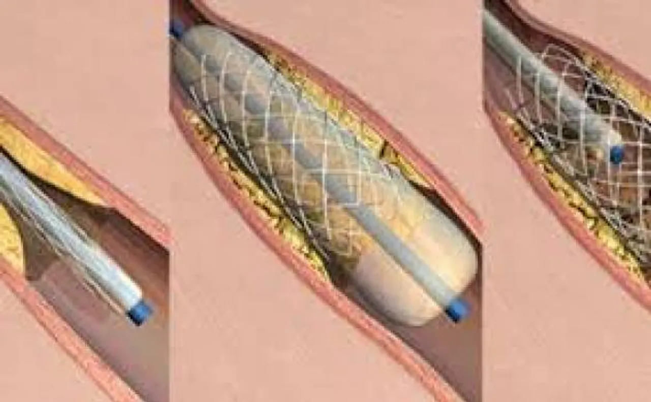 Coronary stents prices slashed by 85%: Govt tells Delhi HC