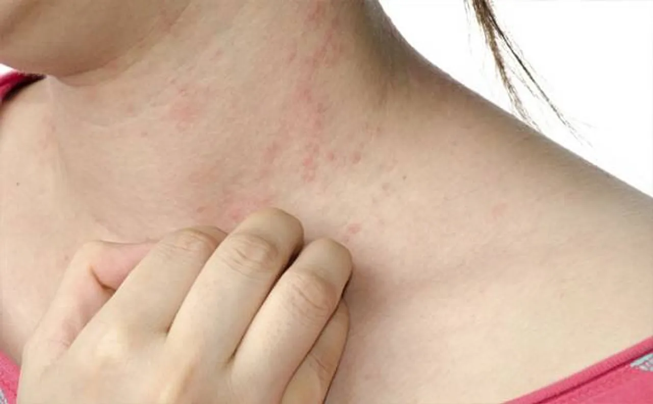 Eczema caused by deficiency of protein in skin, confirm scientists