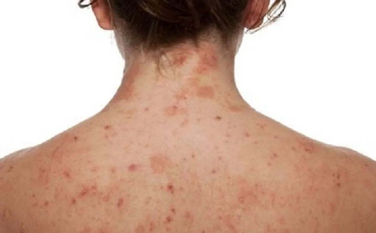 Atopic dermatitis not positively related to cardiovascular diseases: Study