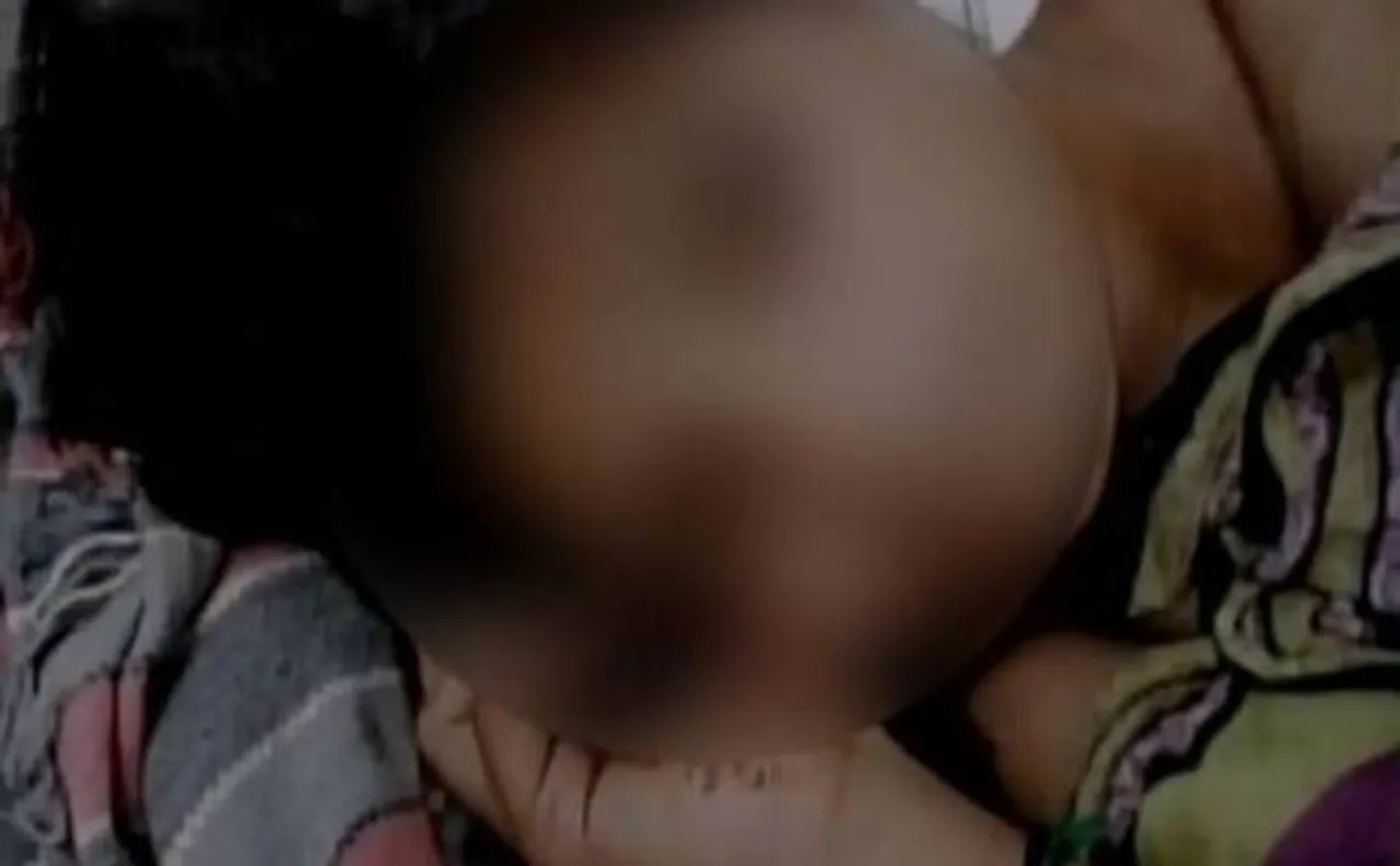 Bareilly (UP): 2 sisters suffer critical burns after unknown persons set them on fire at home 