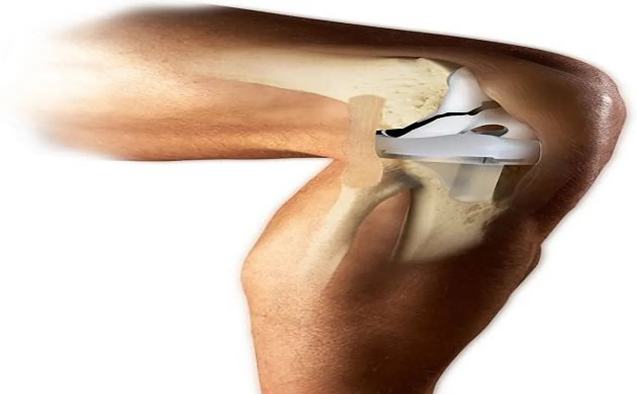 After cardiac stents, government fixes price range for knee implants surgery