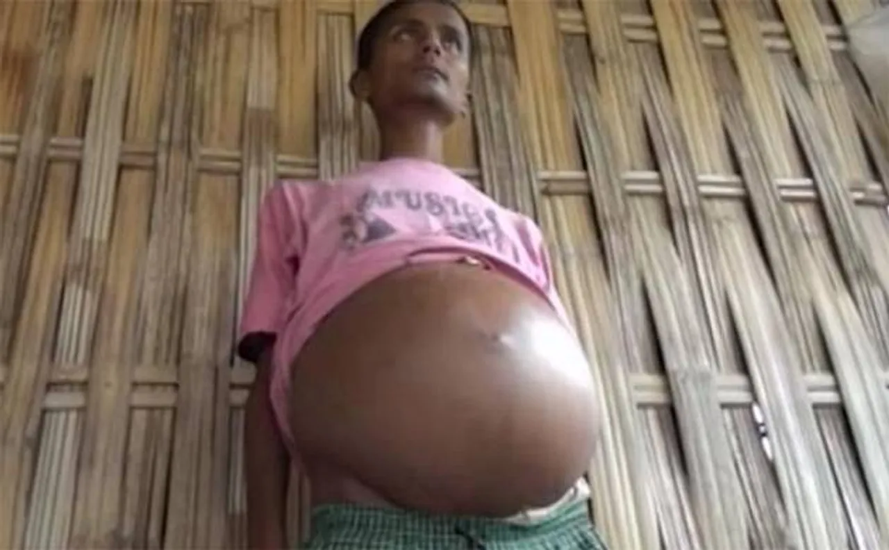 Assam man counting last days of life, stomach swells up to 59 inches causing constant extreme pain