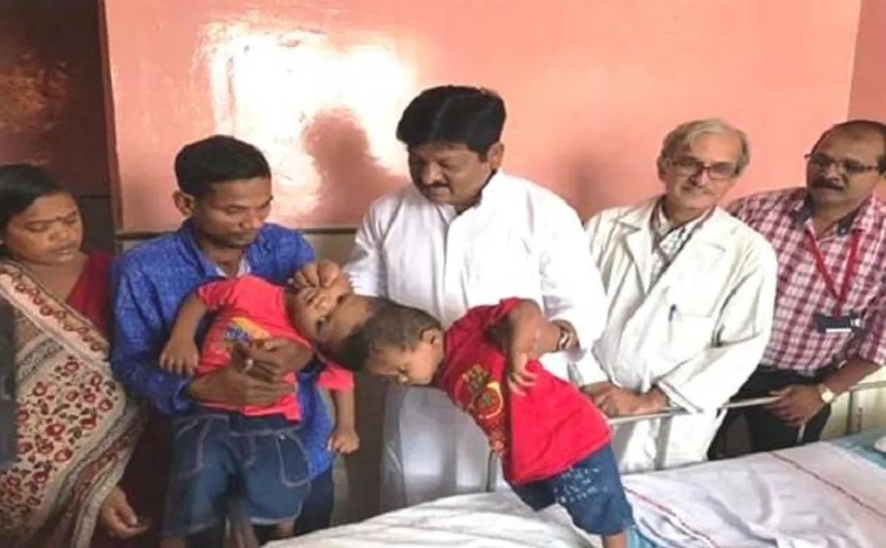 Conjoined twins from Odisha undergo complicated surgery at AIIMS, separated partially