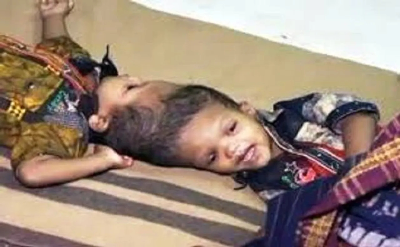 AIIMS to conduct second surgery of conjoined twins Jaga-Kalia in mid-October