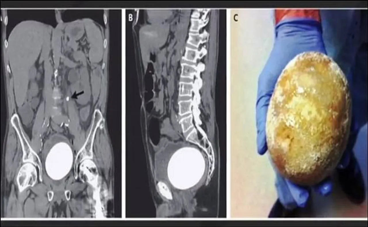 Stone as big as an Ostrich egg removed from man's bladder, doctors California hospital shocked