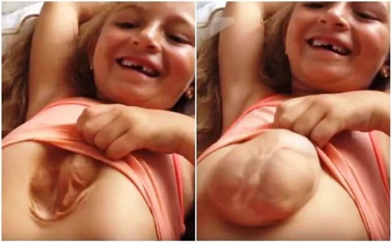 Eight-year-old Russian girl born with heart outside her body, Know more about this rare thoraco-abdominal syndrome