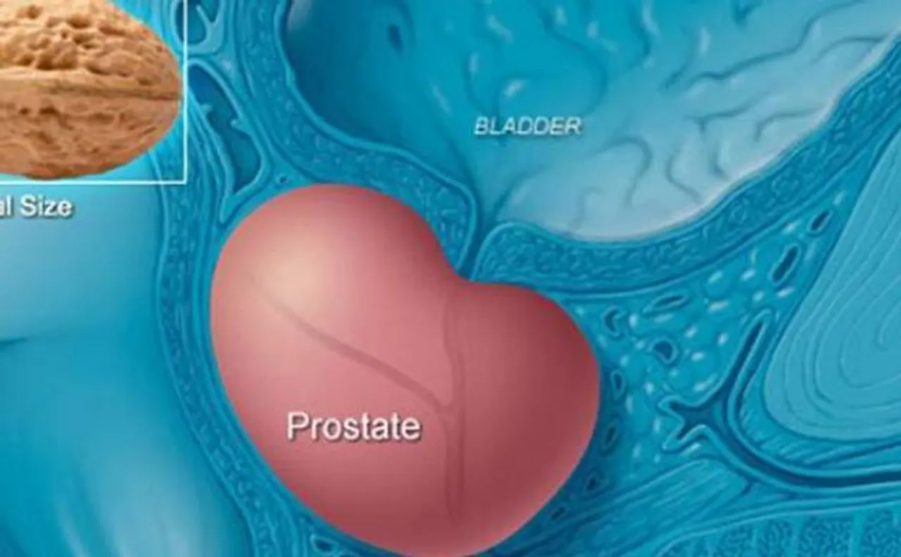 Prostate cancer cases on rise in rural India, experts warn number may double by 2020
